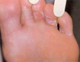 fungal-infection12042013Wd-300x233.jpg fungal-infection12042013Wd-300x233.jpg